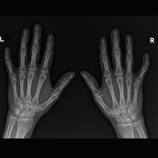 x-ray both hand pa view test